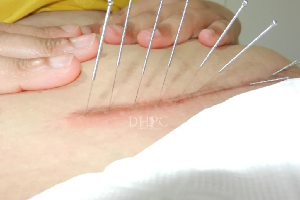 Rehab C-Section Scar