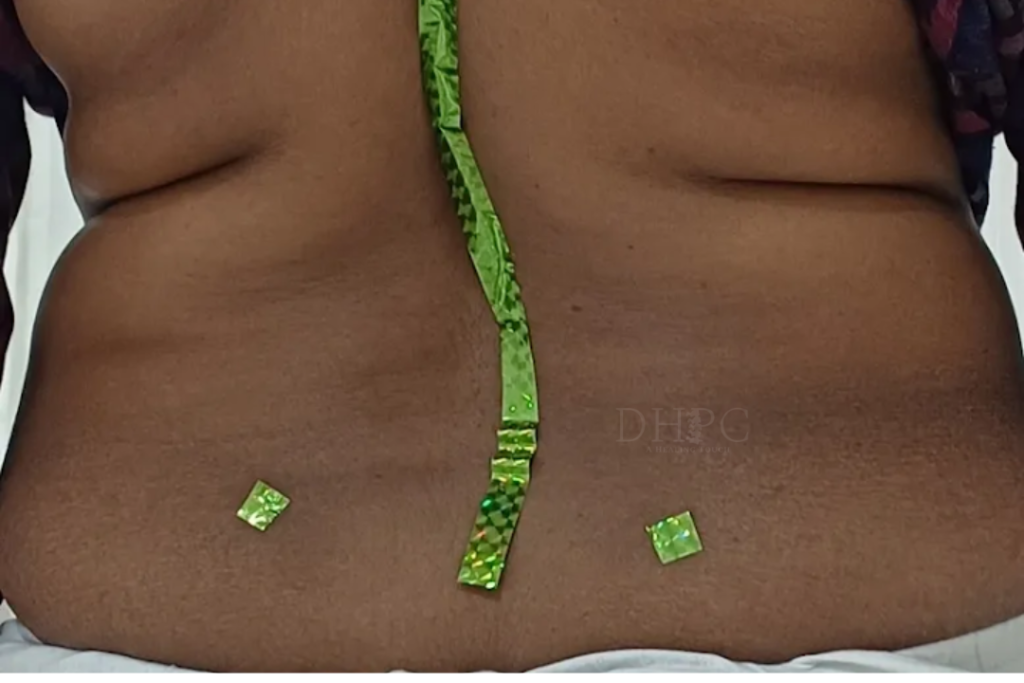 disc bulge physiotherapy treatment