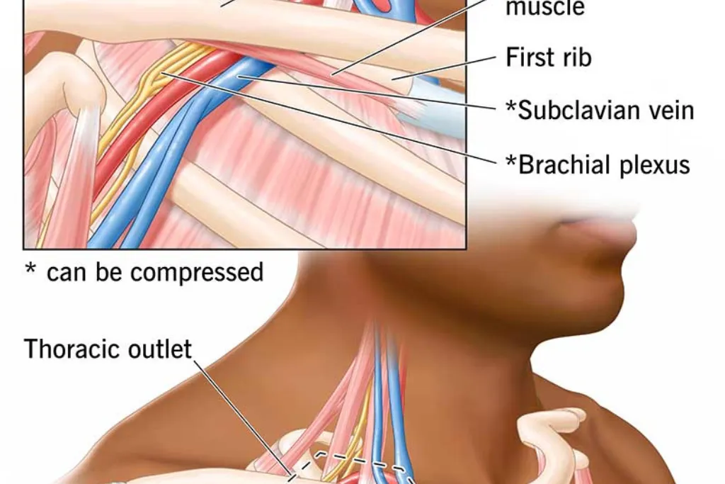 thoracic-outlet -syndrome-treatment with-physiotherapy